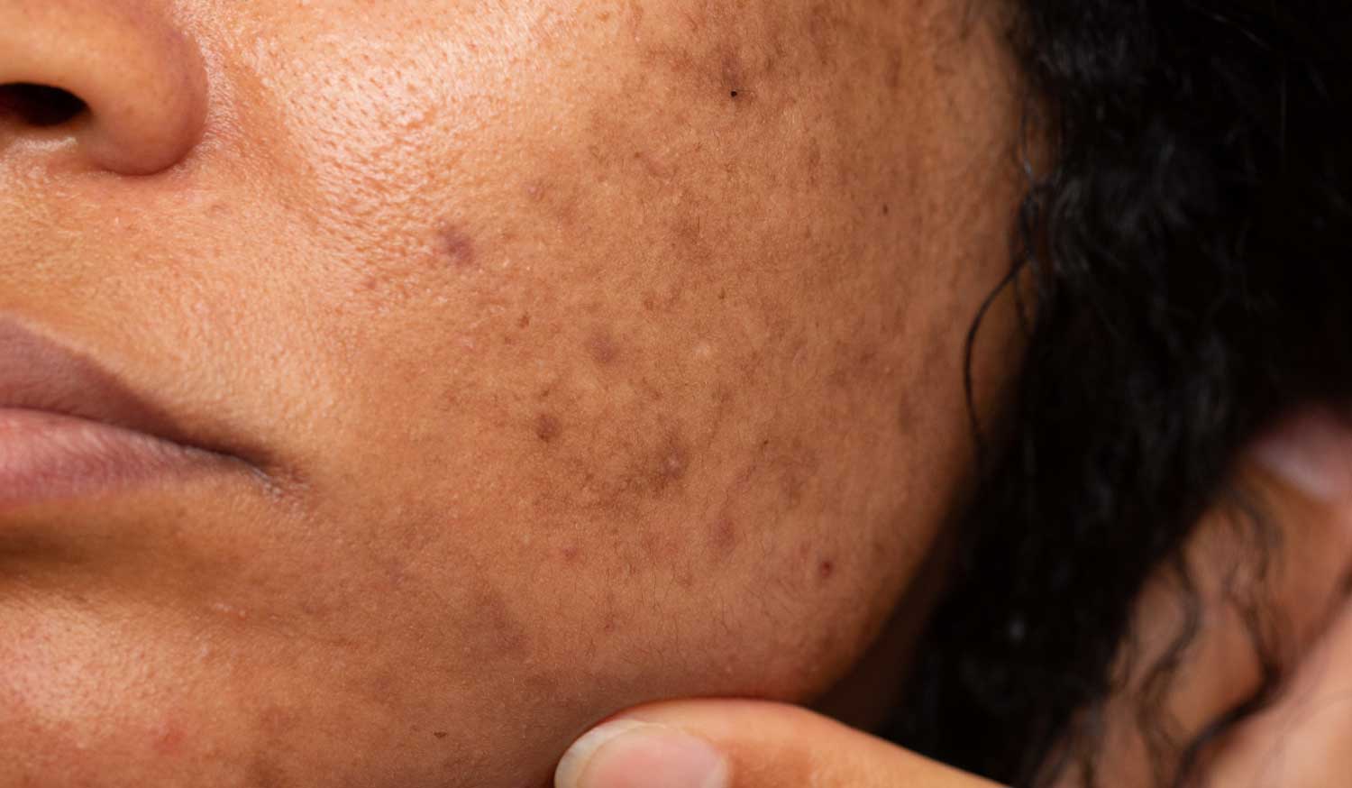 Fade Age Spots
