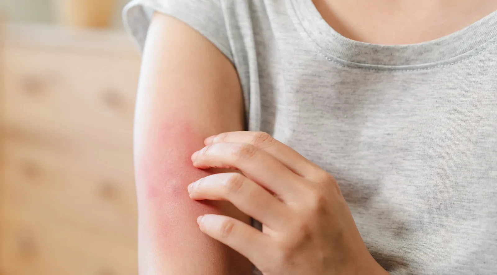 Woman scratching an itchy red patch of dry skin on her upper arm